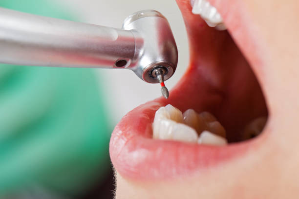 Best Urgent Care for Lost Fillings or Crowns in Apple Valley, CA